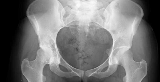 Fracturas cadera osteoporosis