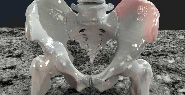 Impresion 3D huesos